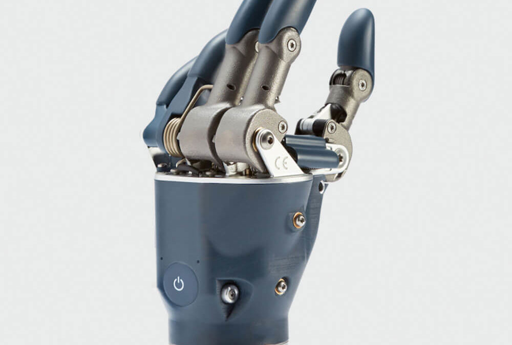 Introduction to Upper Extremity Prosthetics